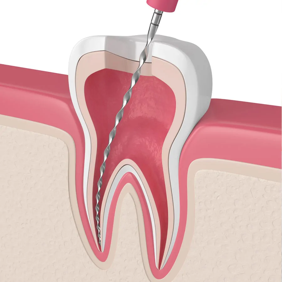 endodoncia madrid dentologies dental endodoncia madrid dentologies dental